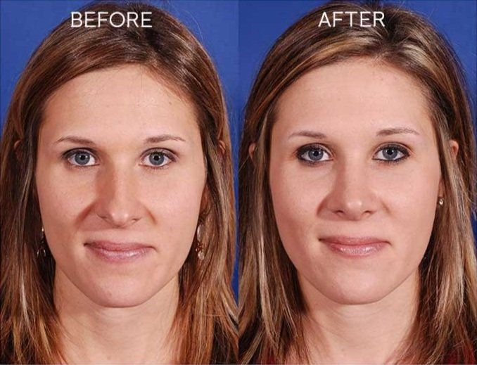facial plastic surgery