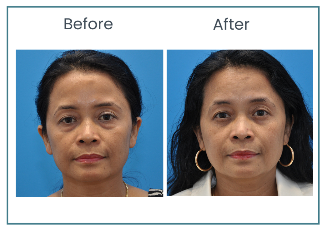 facial procedures