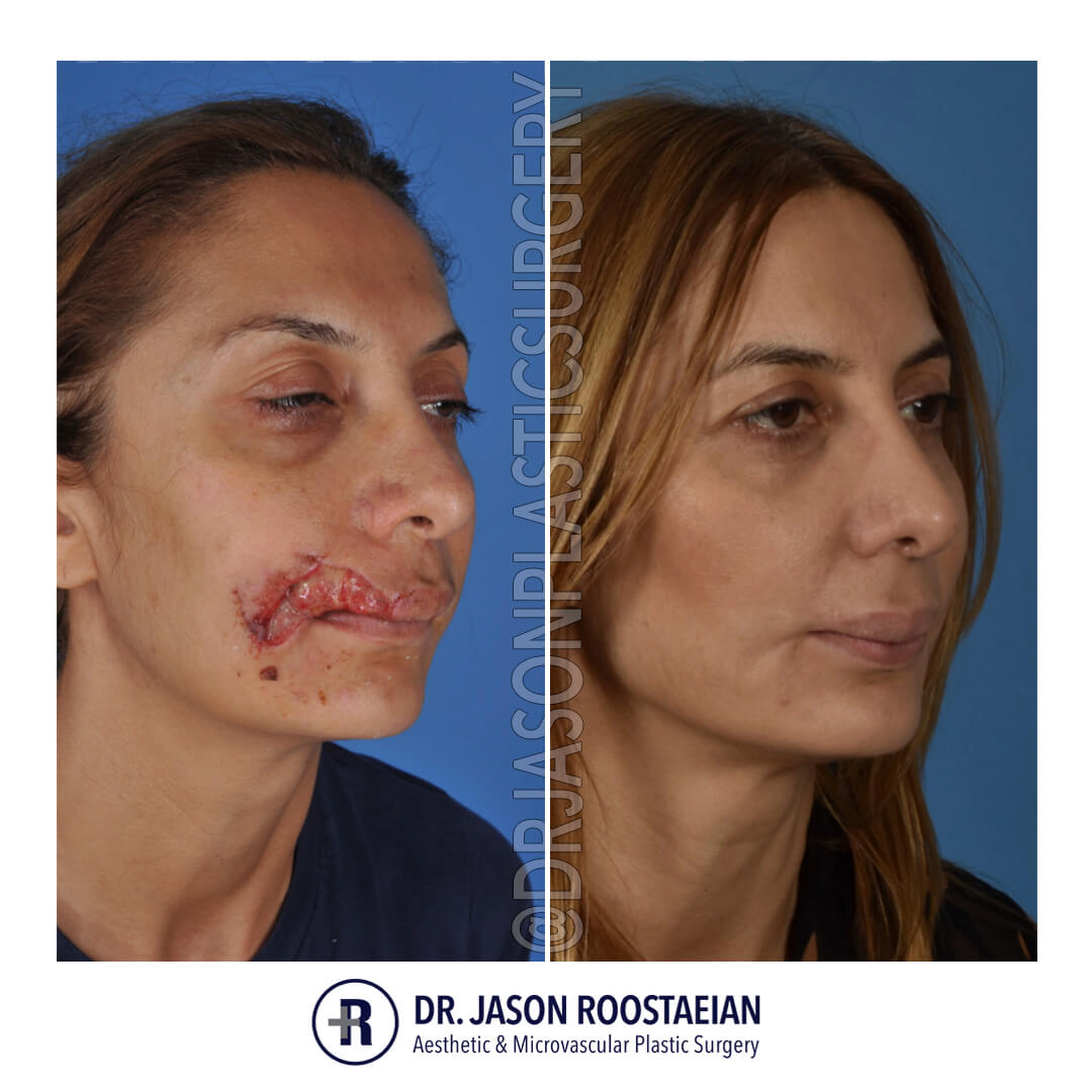 facial reconstruction surgery facial reconstruction surgery