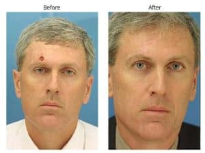 facial reconstruction surgery facial reconstruction surgery