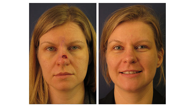 Facial Reconstruction Surgery: Restoring harmony after trauma