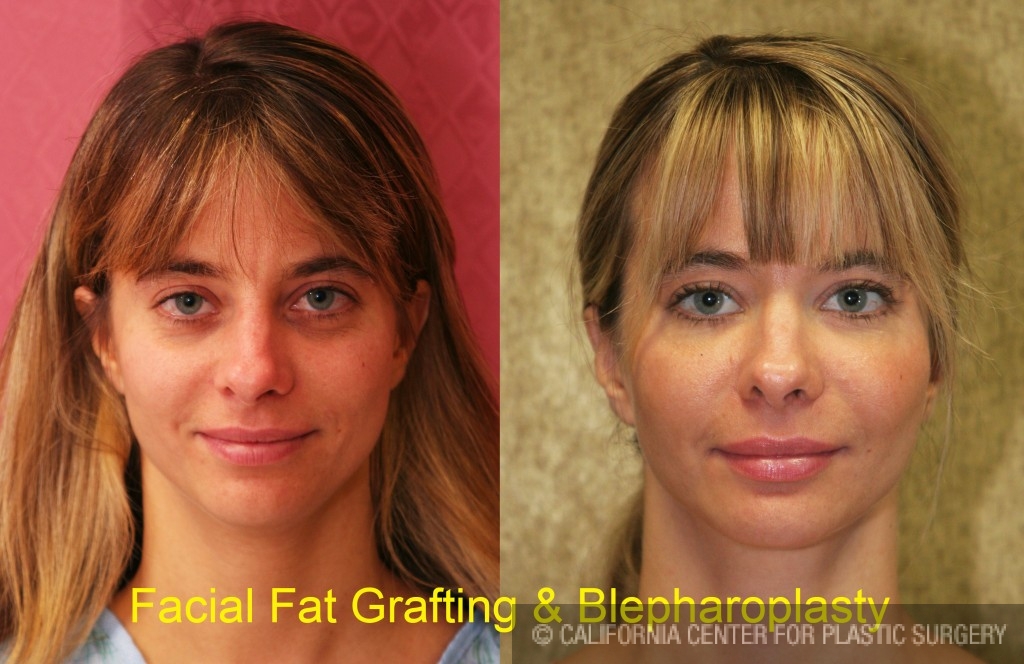 fat grafting cost fat grafting cost