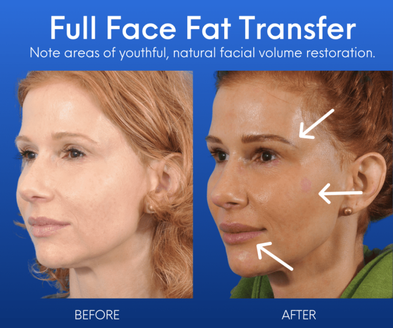 Fat grafting for the face: Restoring volume and contour