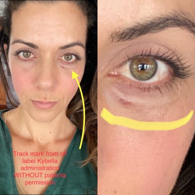 fat grafting under eyes