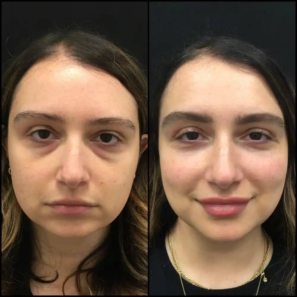 fat grafting under eyes