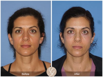 fat grafting under eyes