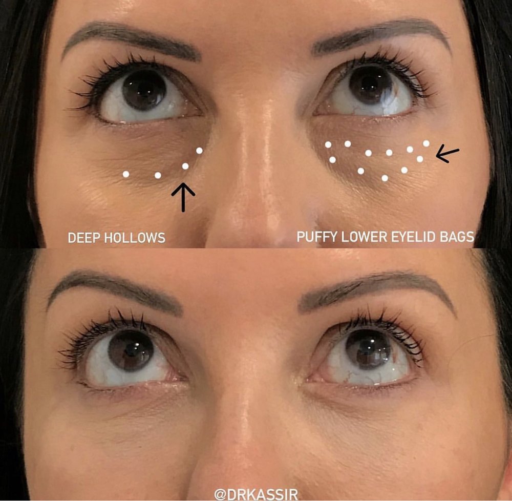fat grafting under eyes