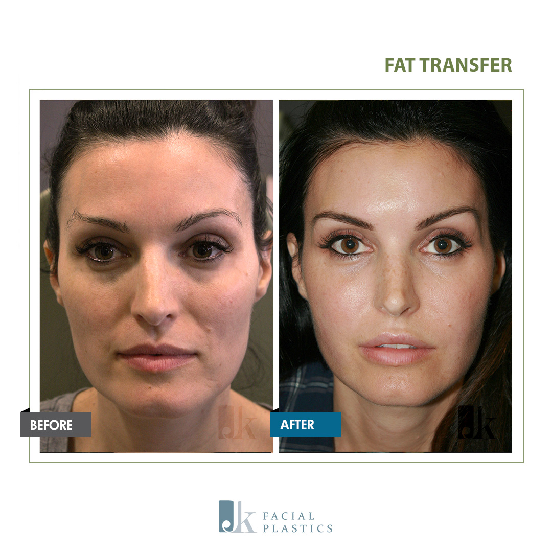 fat injections in face fat injections in face