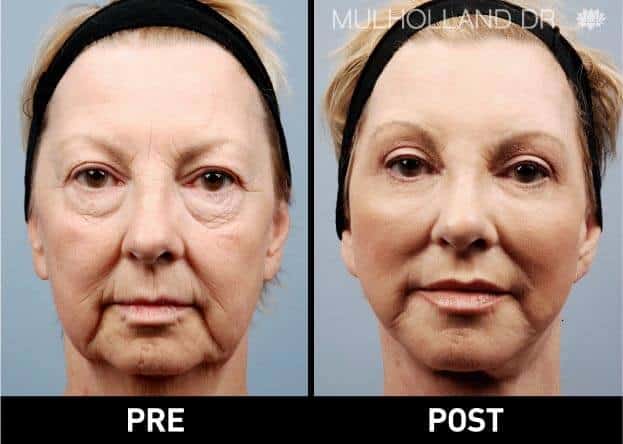 fat injections in face fat injections in face