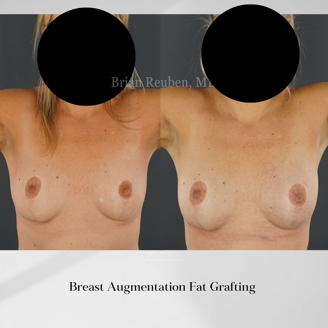 fat transfer boob job fat transfer boob job