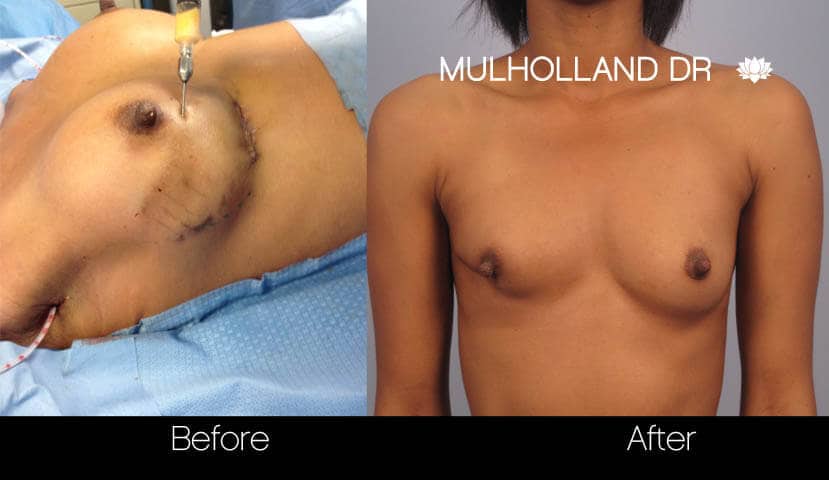 fat transfer boob job fat transfer boob job