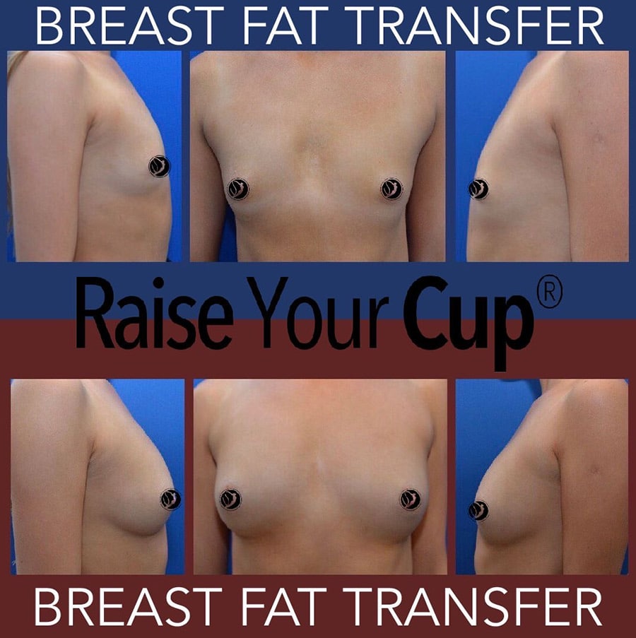 fat transfer boob job fat transfer boob job