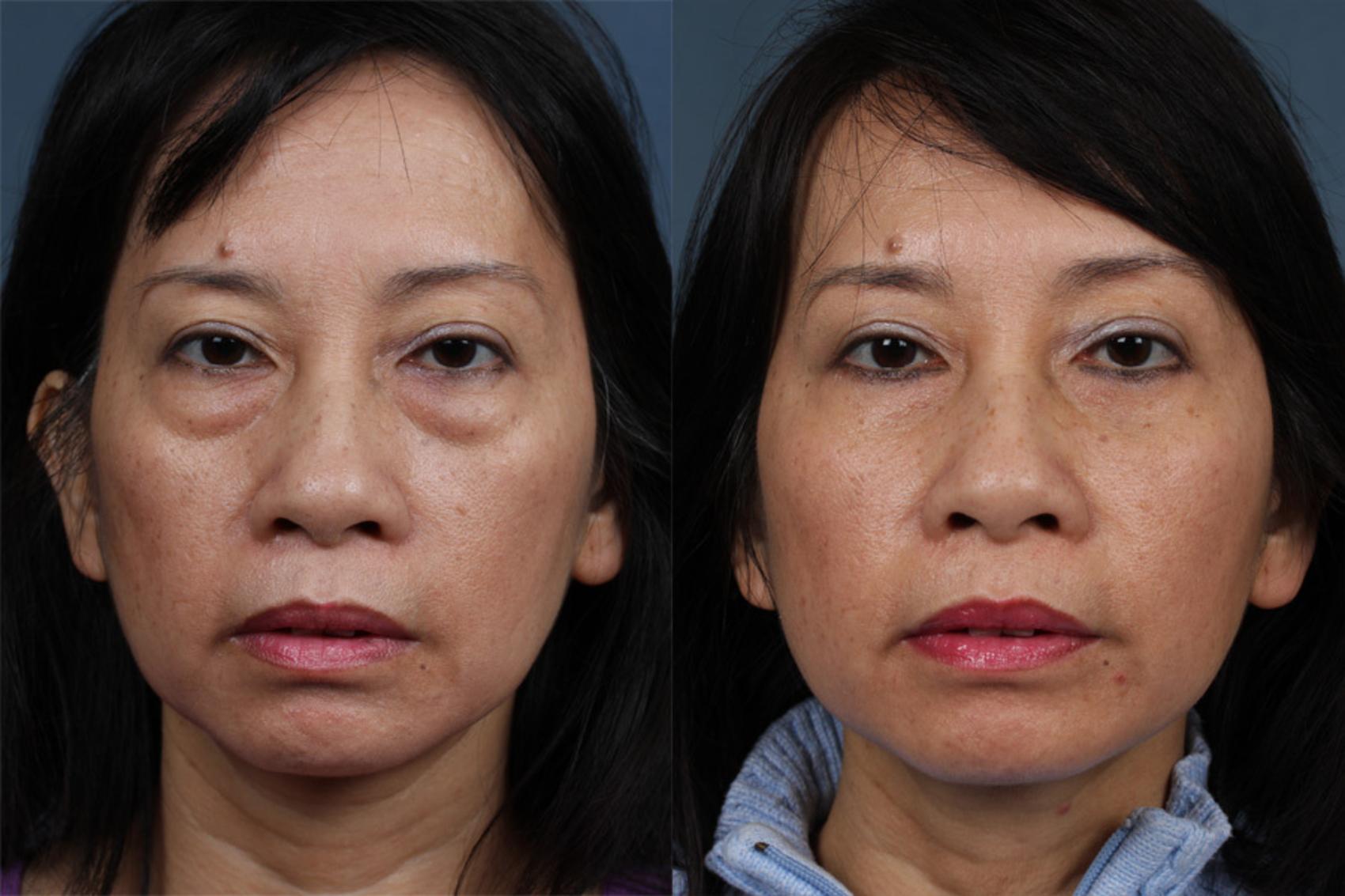 fat transfer cost fat transfer cost