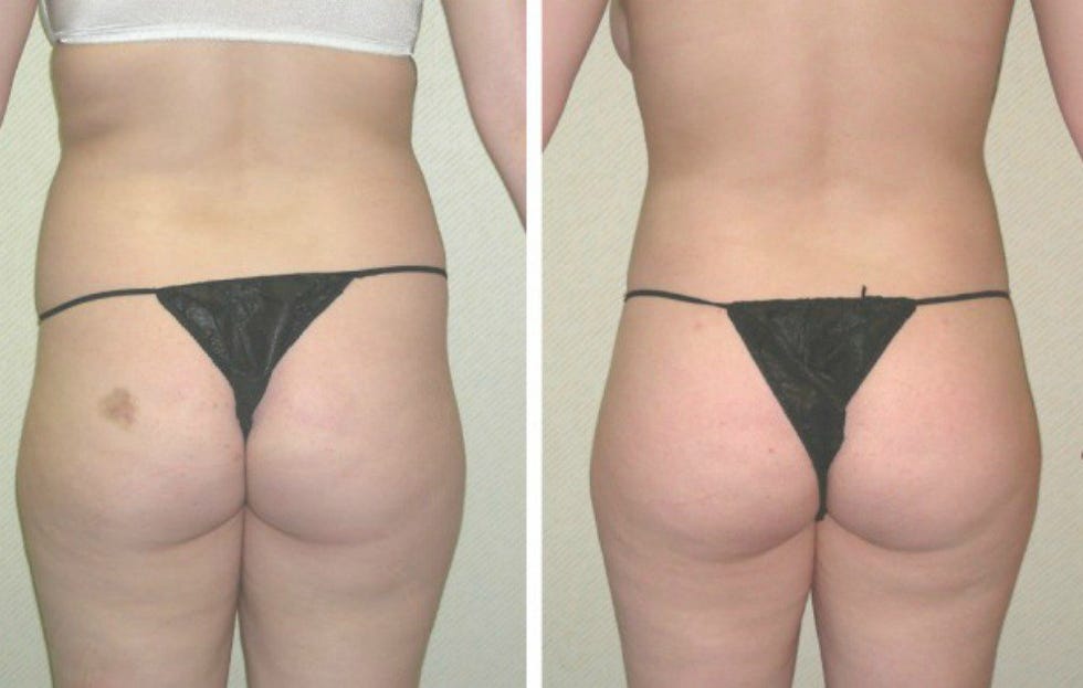fat transfer cost fat transfer cost