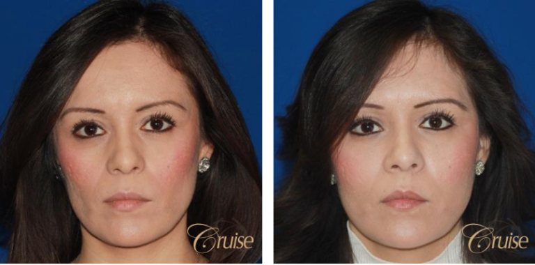 Fat Transfer Cost: Restoring volume naturally
