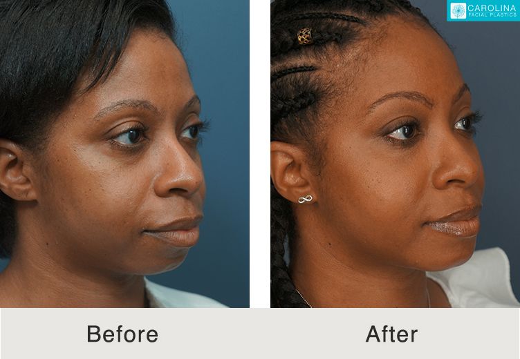 fat transfer cost fat transfer cost