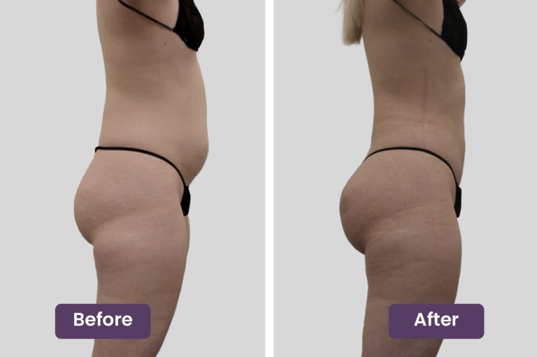Fat Transfer: Enhancing with natural volume
