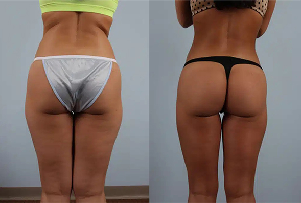 fat transfer from stomach to buttocks cost