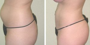 Fat Transfer from Stomach to Buttocks Cost: Natural enhancement pricing