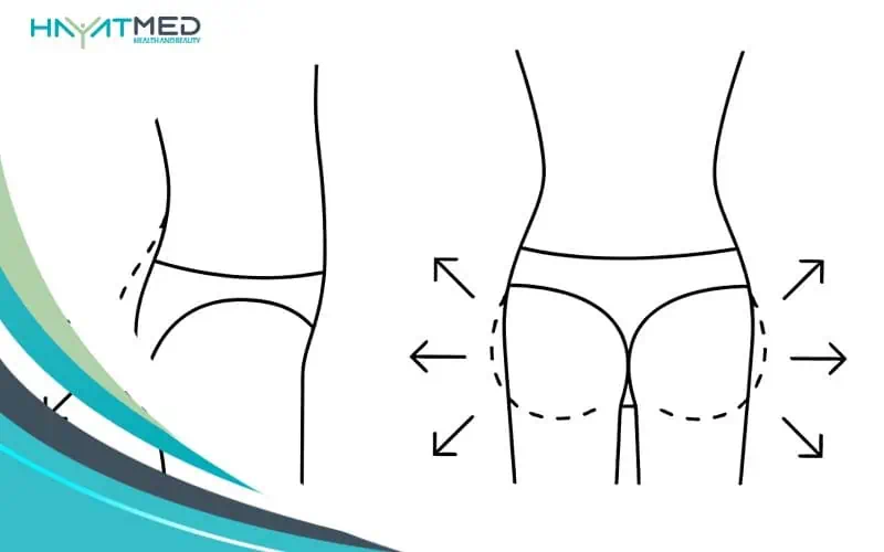 fat transfer from stomach to buttocks cost
