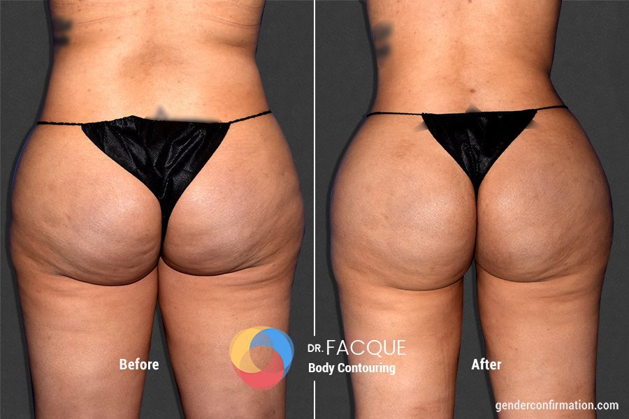 fat transfer from stomach to buttocks