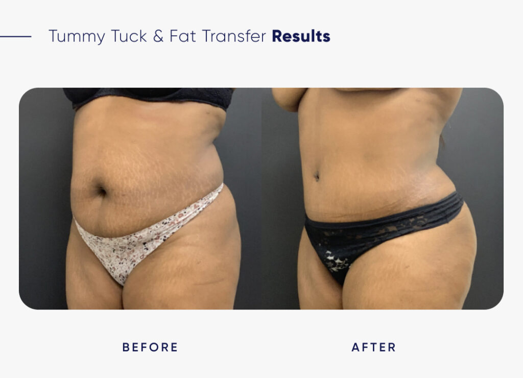 fat transfer from stomach to buttocks