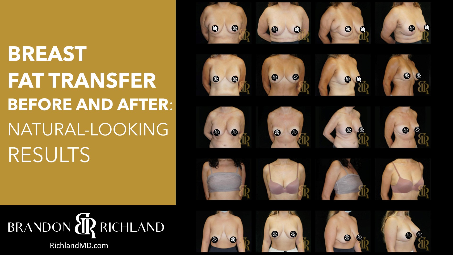 fat transfer to breast fat transfer to breast