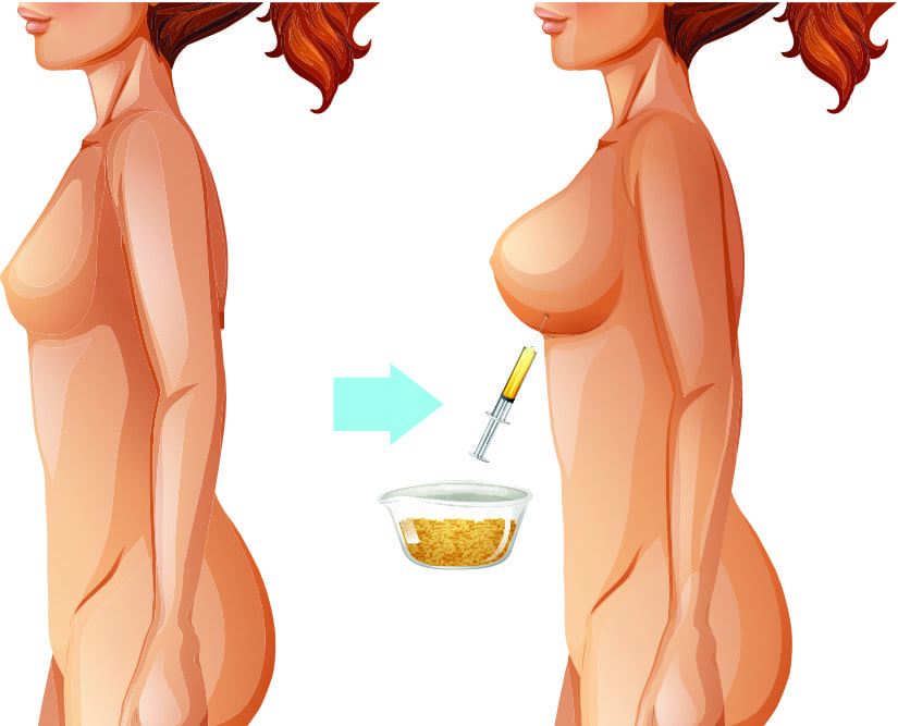 fat transfer to breast fat transfer to breast