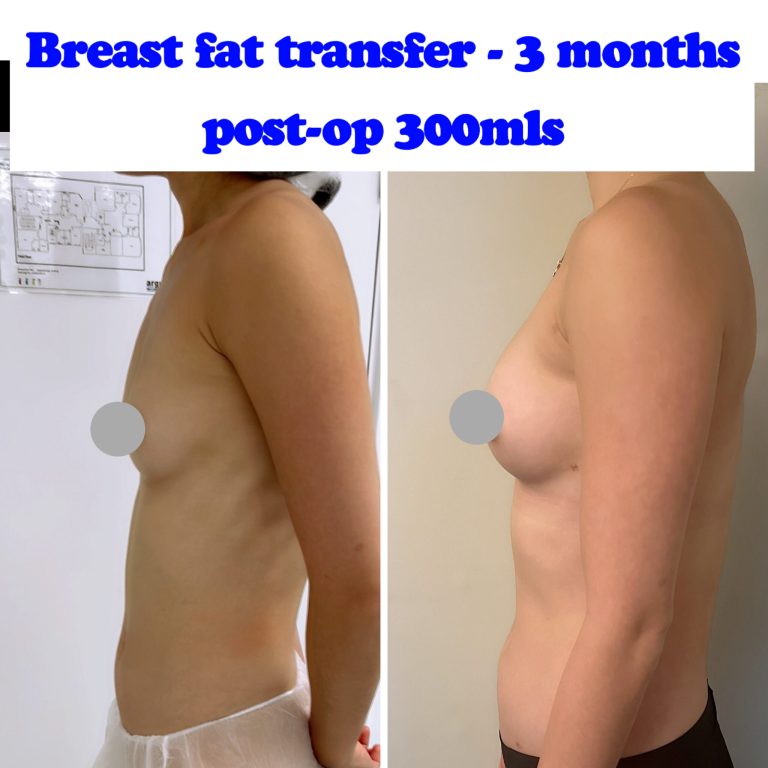 Fat transfer to breast: Natural enhancement options explained