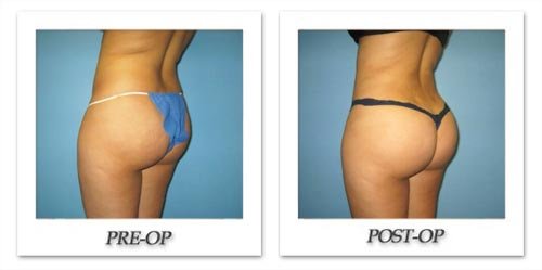 fat transfer to buttocks cost fat transfer to buttocks cost