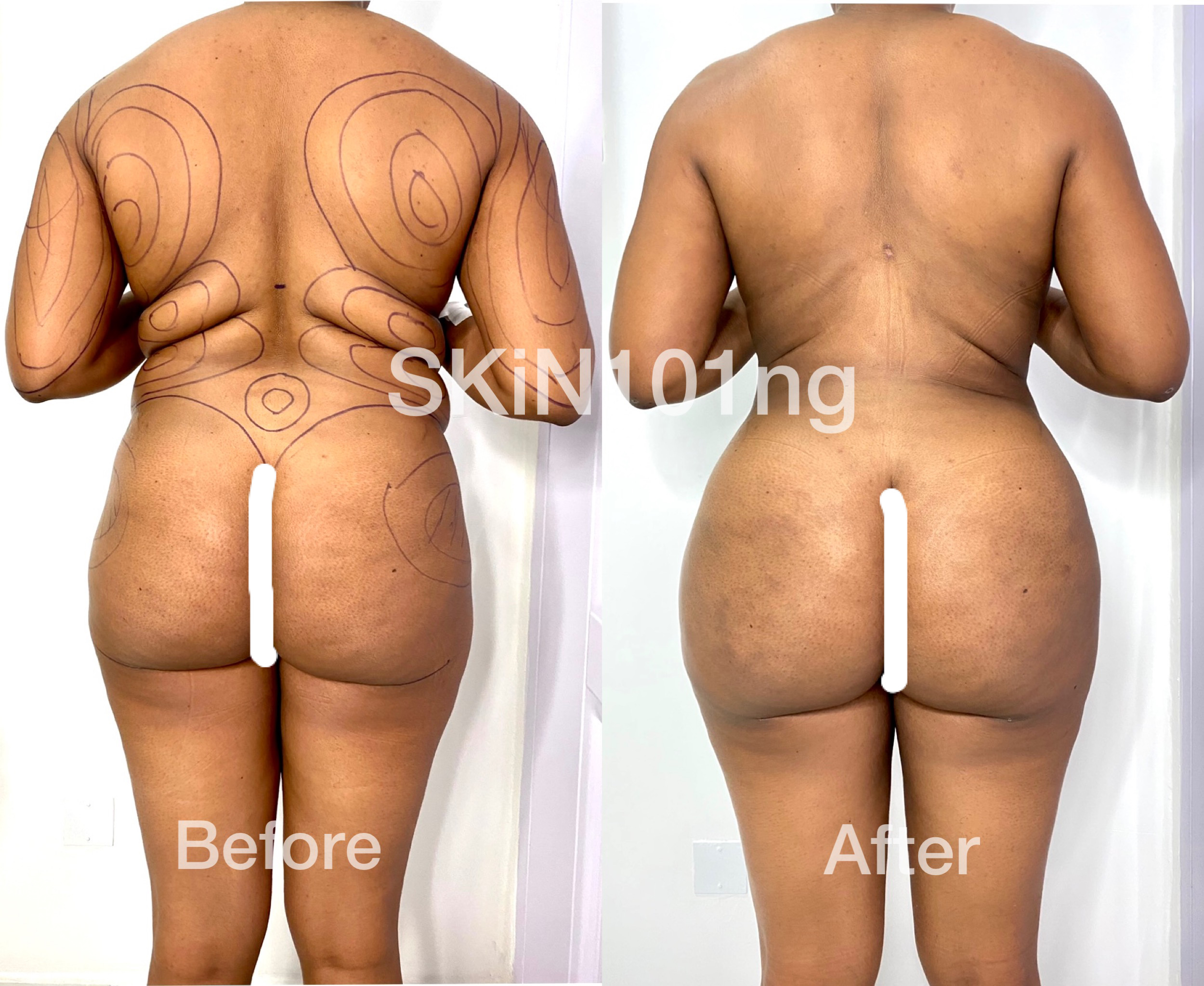 fat transfer to buttocks cost fat transfer to buttocks cost