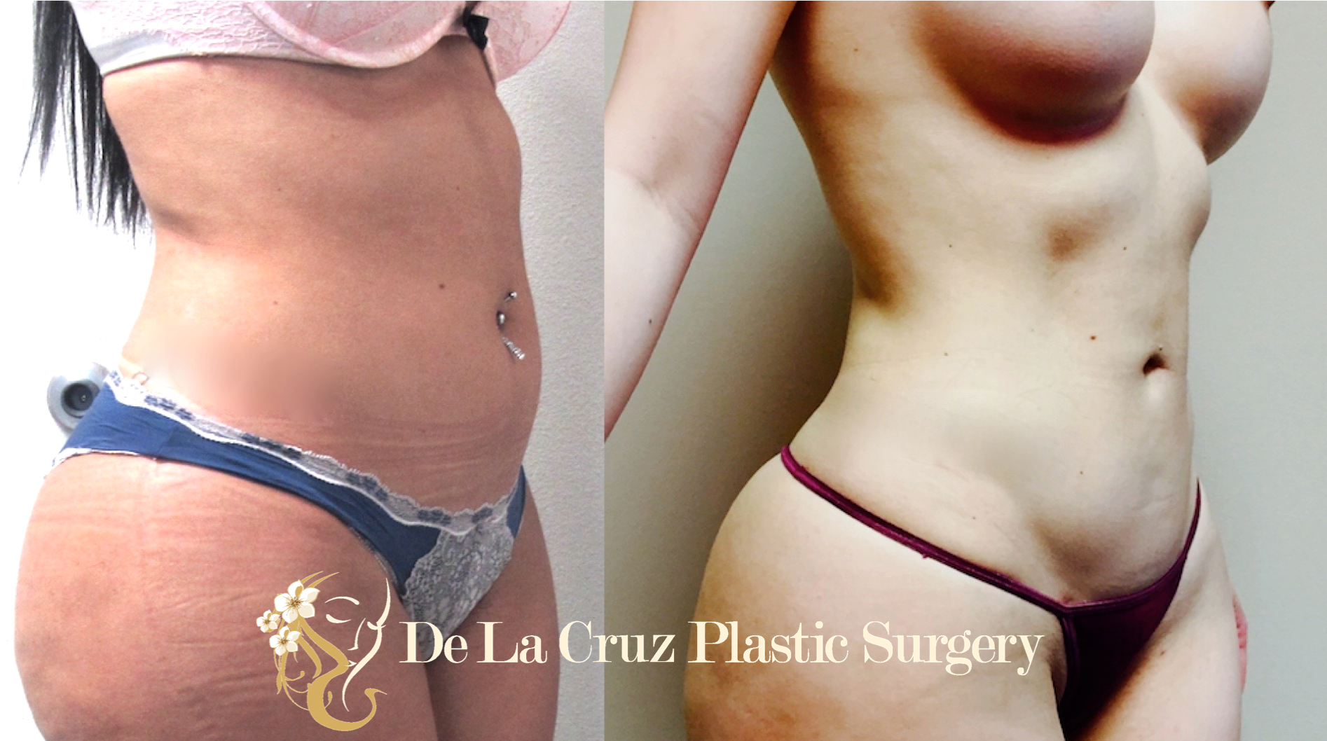 fat transfer to buttocks cost fat transfer to buttocks cost