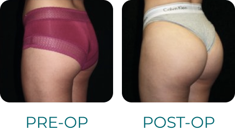 fat transfer to buttocks fat transfer to buttocks