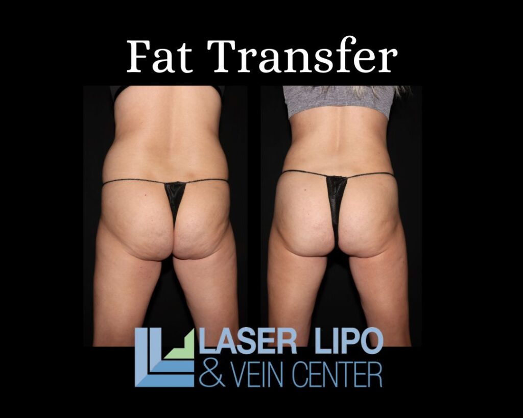 fat transfer to buttocks fat transfer to buttocks