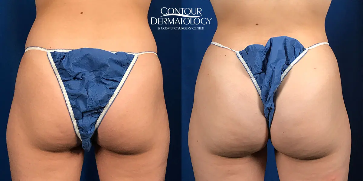 fat transfer to buttocks fat transfer to buttocks
