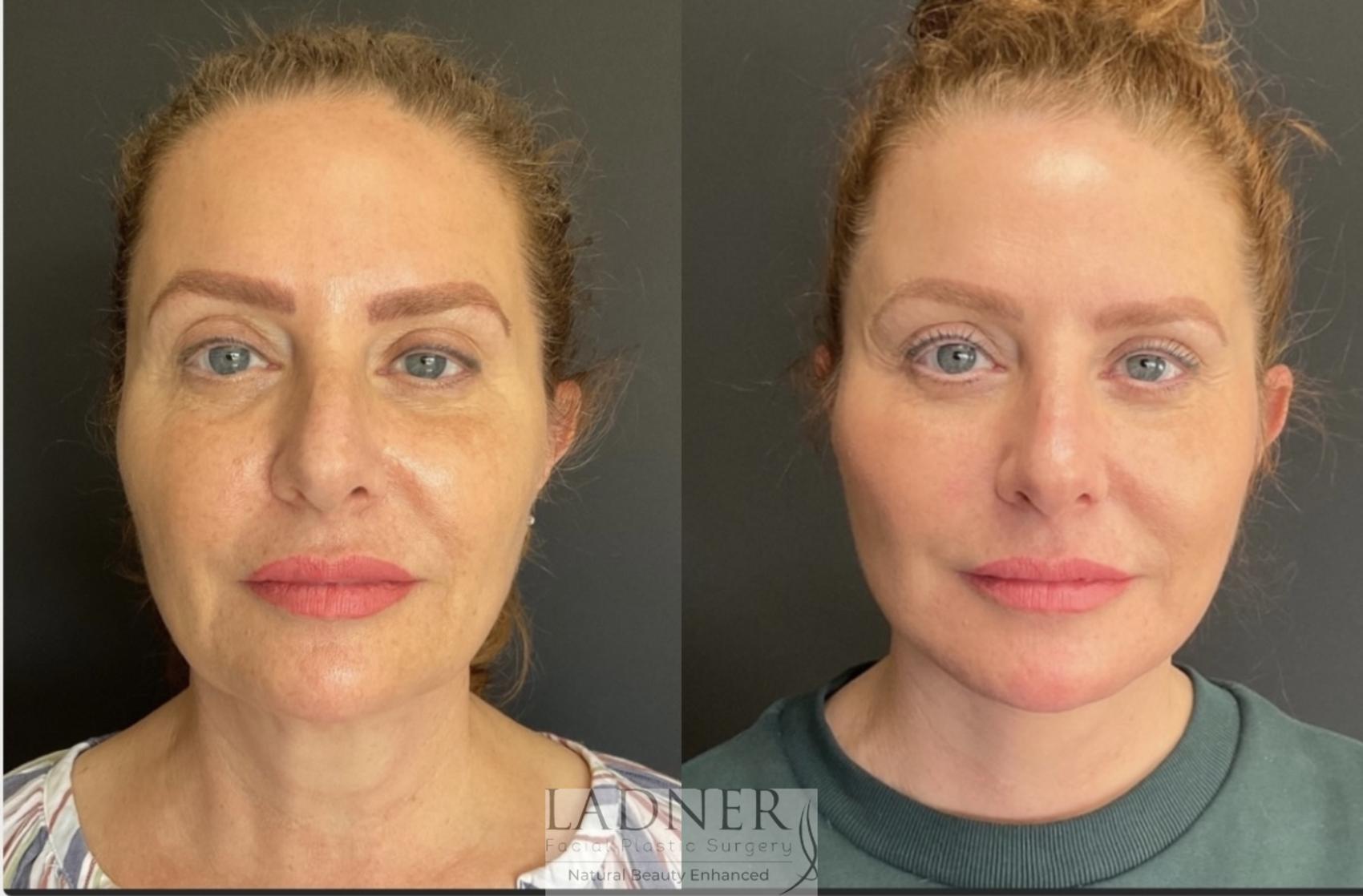 fat transfer to face fat transfer to face