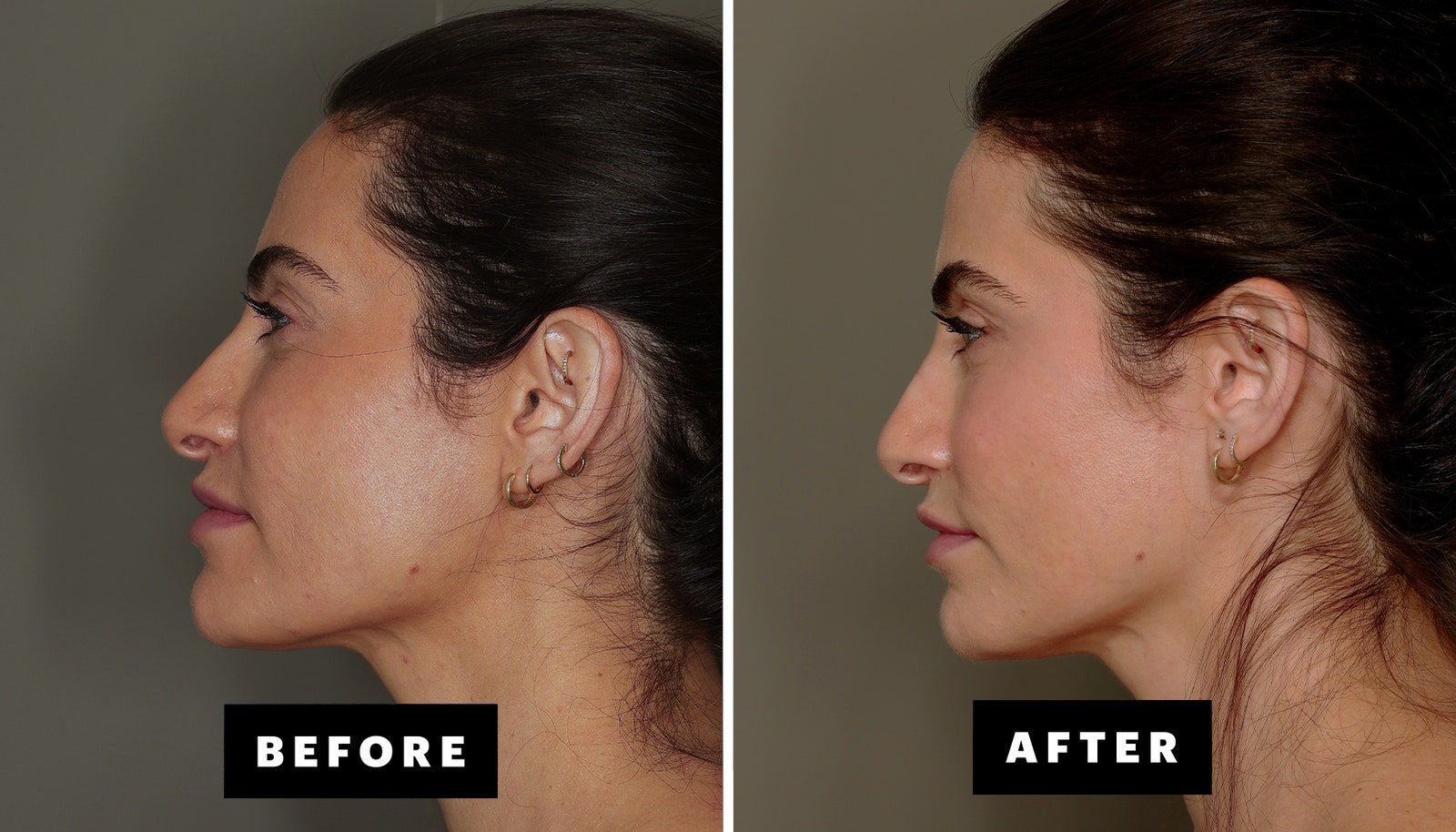 fat transfer to face fat transfer to face
