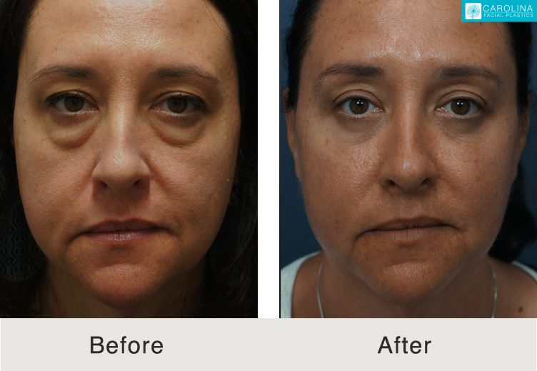 fat transfer to face fat transfer to face