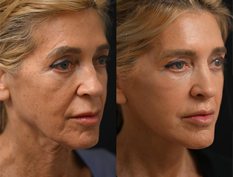 fat transfer to face cost fat transfer to face cost