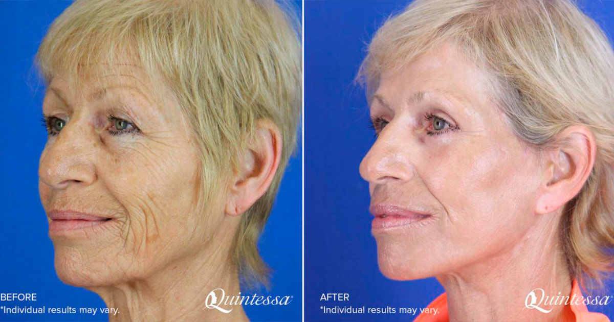 fat transfer to face cost fat transfer to face cost