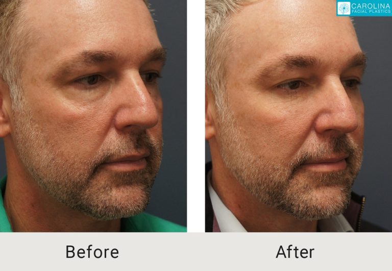 Fat transfer to face cost: Restoring volume for a youthful look