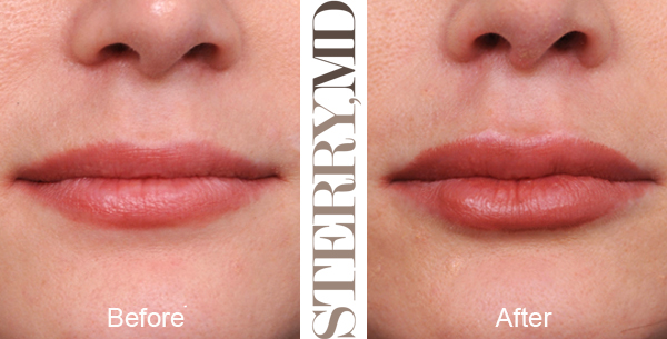 fat transfer to lips