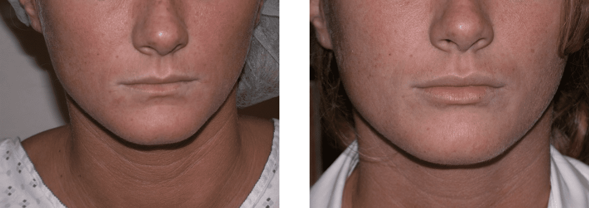 fat transfer to lips