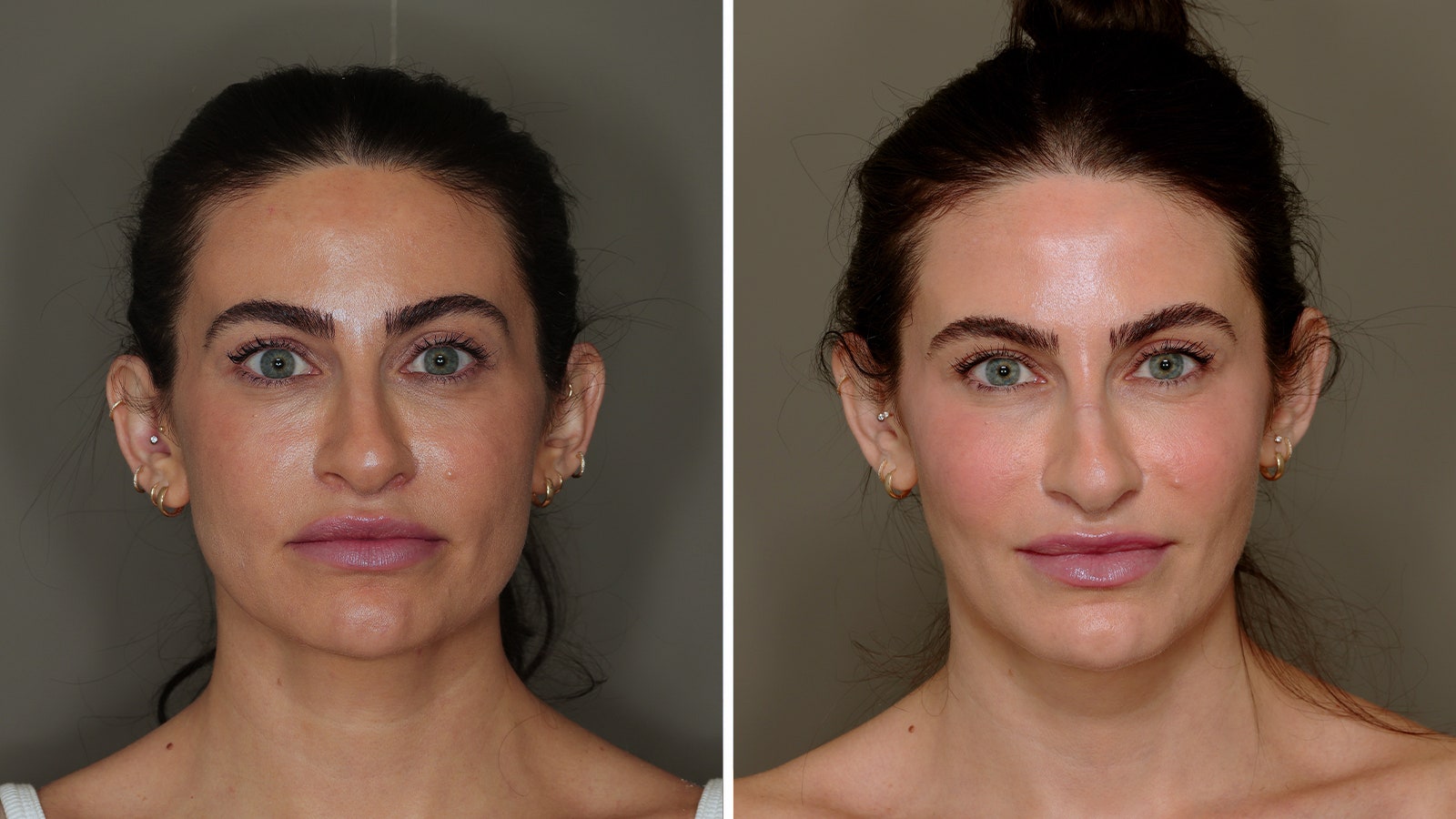 fat transfer to lips