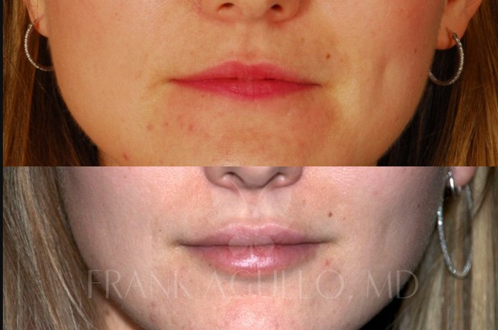 Fat transfer to lips: Achieving fullness naturally