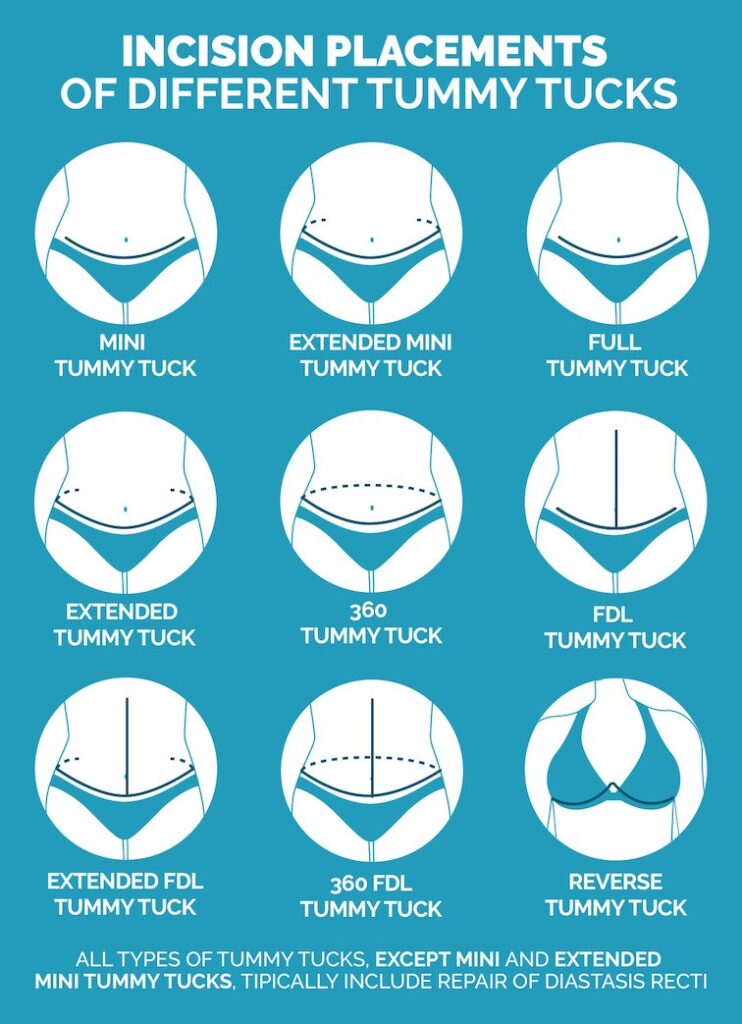 fdl tummy tuck