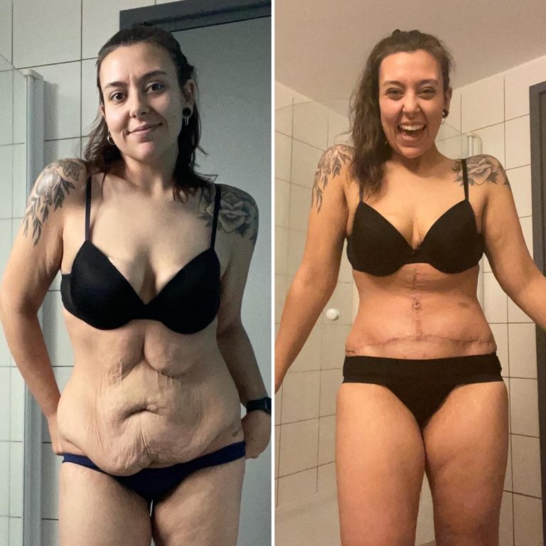 FDL tummy tuck: Achieving a flatter, smoother abdomen