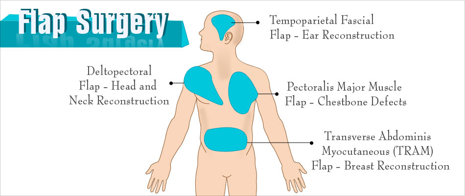 flap procedure flap procedure