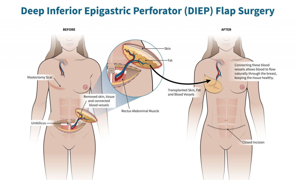 flap procedure flap procedure