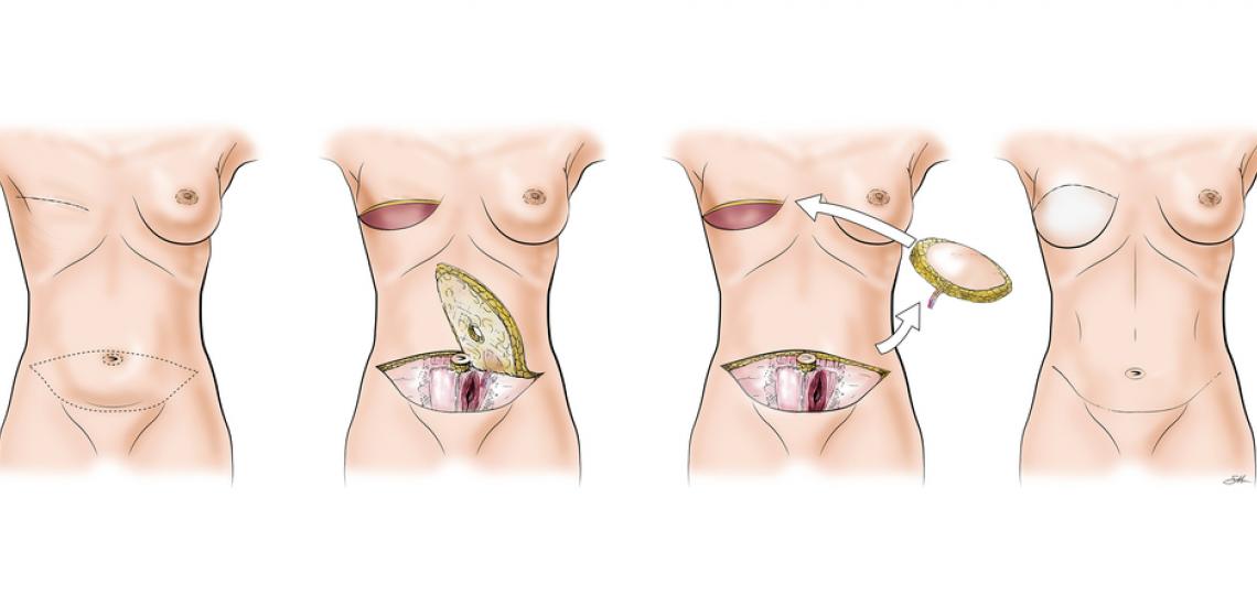 flap procedure flap procedure